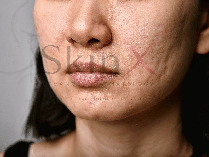 Sẹo rỗ lâu năm càng cần thời gian điều trị dài hơn